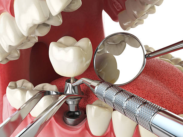 Best Emergency Broken Tooth Repair in Monument, CO